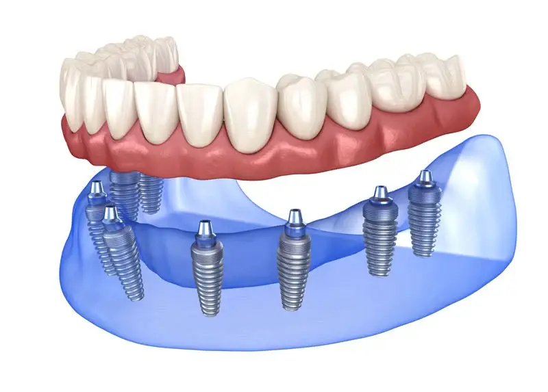 Dental Photo